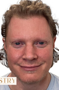 After Image: Male Facial Rejuvenation