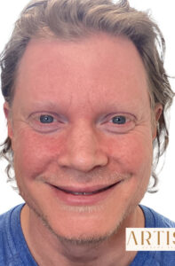 Before Image: Male Facial Rejuvenation